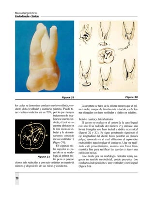 Manual de prácticas
Endodoncia clínica




                                           Figura 29                                                  Figura 30


los cuales se denominan conducto mesio-vestibular, con-     La apertura se hace de la misma manera que el pri-
ducto disto-vestibular y conducto palatino. Puede te-     mer molar, aunque de tamaño más reducido, es de for-
ner cuatro conductos en un 70%, por lo que siempre        ma triangular con base vestibular y vértice en palatino.
                                  trataremos de loca-
                                  lizar ese cuarto con-   Incisivo central y lateral inferior
                                  ducto, el cual se en-       El acceso se realiza en el centro de la cara lingual
                                  cuentra ubicado en      con una fresa redonda del número 2 y dándole una
                                  la raíz mesio-vesti-    forma triangular con base incisal y vértice en cervical
                                  bular y le denomi-      (figuras 32 y 33). Se sigue penetrando siguiendo el
                                  naremos conducto        eje longitudinal del diente hasta penetrar en cámara
                                  mesio-vestibular 2      pulpar, momento en el cual utilizamos el explorador
                                  (figura 31).            endodóntico para localizar el conducto. Una vez reali-
                                      El segundo mo-      zado este procedimiento, usamos una fresa tron-
                                  lar superior es pa-     cocónica fina para rectificar las paredes y hacer una
                                  recido en su morfo-     extensión incisal.
                     Figura 31 logía al primer mo-            Este diente por su morfología radicular (muy an-
                                  lar, pero en propor-    gosto en sentido mesiodistal, puede presentar dos
ciones más reducidas y con más variantes en cuanto al     conductos independientes: uno vestibular y otro lingual
número y disposición de sus raíces y conductos.           (figura 34).



20
 