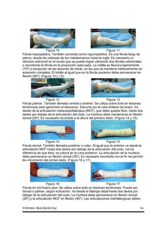 Enfermera: Rocío Burelo Cruz 94
Figura 10 Figura 11
Férula isquiopédica: También conocida como inguinopédica. Es una férula larga de
pierna, desde las cabezas de los metatarsianos hasta la ingle. Es necesario un
refuerzo adicional en el muslo que se puede lograr utilizando dos férulas adicionales
o recortando la férula en la proporción adecuada. La rodilla se flexiona ligeramente
(15º) a excepción de las lesiones de rótula, en las que se mantiene habitualmente en
extensión completa. El tobillo al igual que en la férula posterior debe permanecer en
flexión (90º). (Figura 12 y 13).
Figura 12 Figura 13
Férula palmar. También llamada ventral o anterior. Se utiliza sobre todo en lesiones
tendinosas para garantizar el descanso. Discurre por la cara anterior de brazo. Va
desde de la articulación metacarpofalángica (MCF), que debe quedar libre, hasta dos
dedos por debajo de la articulación del codo. La muñeca debe mantenerse en flexión
dorsal (30º). Es necesario recortarla a la altura del primero dedo. (Figura 14 y 15).
Figura 14 Figura 15
Férula dorsal. También llamada posterior o volar. Al igual que la anterior va desde la
articulación MCF hasta dos dedos por debajo de la articuación del codo, con la
diferencia de que ésta, se coloca en la cara posterior. La articulación de la muñeca
debe permanecer en flexión dorsal (30º). Es necesario recortarla con el fin de permitir
los movimento del primer dedo. (Figura 16 y 17).
Figura 16 Figura 17
Férula en intrínseco plus: Se utiliza sobre todo en lesiones tendinosas. Puede ser
dorsal o palmar, según indicación. Va desde la falange distal hasta dos dedos por
debajo de la articulación del codo. La muñeca debe permanecer en flexión dorsal
(30º) y la articulación MCF en flexión (90º). Las articulaciones interfalangicas deben
 