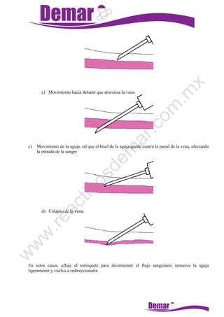 c) Movimiento hacia delante que atraviesa la vena.
c) Movimiento de la aguja, tal que el bisel de la aguja quede contra la pared de la vena, afectando
la entrada de la sangre
d) Colapso de la vena:
En estos casos, afloje el torniquete para incrementar el flujo sanguíneo, remueva la aguja
ligeramente y vuelva a redireccionarla.
 