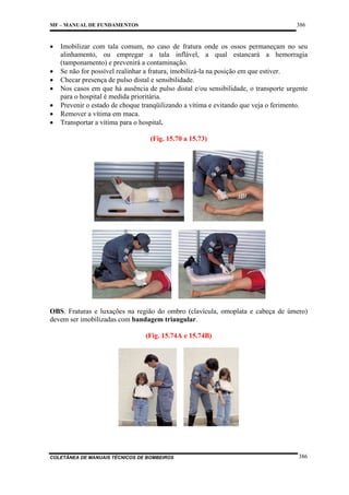 386

MF – MANUAL DE FUNDAMENTOS

•
•
•
•
•
•
•

Imobilizar com tala comum, no caso de fratura onde os ossos permaneçam no seu
alinhamento, ou empregar a tala inflável, a qual estancará a hemorragia
(tamponamento) e prevenirá a contaminação.
Se não for possível realinhar a fratura, imobilizá-la na posição em que estiver.
Checar presença de pulso distal e sensibilidade.
Nos casos em que há ausência de pulso distal e/ou sensibilidade, o transporte urgente
para o hospital é medida prioritária.
Prevenir o estado de choque tranqüilizando a vítima e evitando que veja o ferimento.
Remover a vítima em maca.
Transportar a vítima para o hospital.
(Fig. 15.70 a 15.73)

OBS. Fraturas e luxações na região do ombro (clavícula, omoplata e cabeça de úmero)
devem ser imobilizadas com bandagem triangular.
(Fig. 15.74A e 15.74B)

COLETÂNEA DE MANUAIS TÉCNICOS DE BOMBEIROS

386

 