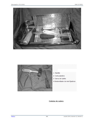 Descargado el: 15-12-2014 ISSN 1727-897X
Medisur 806 octubre 2014 | Volumen 12 | Numero 5
Cubetas de cadera
 
