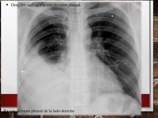 • Describir radiografía con derrame pleural.
Rx con derrame pleural de la lado derecho
 