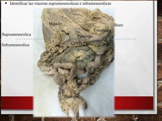 • Identificar las vísceras supramesocolicas e inframesocolicas
Colon transverso
Yeyuno
Íleon
Ciego
Apéndice
Colon
ascendente
Colon
descendente
Sigmoides
Recto
Hígado
Estomago
Bazo
PáncreasSupramesocolica
Inframesocolica
 