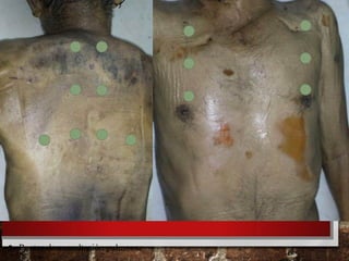 • Puntos de auscultación pulmonar
 