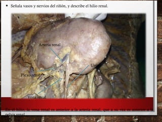 • Señala vasos y nervios del riñón, y describe el hilio renal.
Arteria renal
Vena renal
Uréter
Plexo renal
En el hilio, la vena renal es anterior a la arteria renal, que a su vez es anterior a la
pelvis renal.
Vista posterior
 