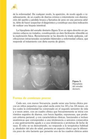 de la enfermedad. De cualquier modo, la aparición, de modo agudo o in-
sidiosamente, de un cuadro de diarrea crónica o intermitente con disminu-
ción del apetito y pérdida brusca y llamativa de peso en una persona adul-
ta, debe de hacer sospechar el diagnóstico y constituye una clara indicación
de realizar una biopsia intestinal.
La hipoplasia del esmalte dentario (figura 5) es un signo descrito en pa-
cientes celíacos no tratados, constituyendo un dato fácilmente obtenible en
la exploración física. Recientemente se ha descrito la tríada epilepsia, cal-
cificaciones intracraneales occipitales bilaterales y enfermedad celíaca, que
responde al tratamiento con dieta exenta de gluten.
40
Figura 5.
Hipoplasia
del esmalte
dentario
Forma de comienzo precoz
Cada vez, con menor frecuencia, puede verse una forma clínica pre-
coz en niños pequeños cuya edad oscila entre los 10 y los 18 meses, en
los cuales la enfermedad ha comenzado en el segundo semestre de vida
y a veces antes, con un cuadro clínico que frecuentemente se inicia con
vómitos seguidos de diarrea, con heces líquidas, espumosas, que produ-
cen eritema perianal, y con características clínicas, funcionales e incluso
anatómicas que corresponden a una intolerancia a azúcares consecutiva
a una gastroenteritis aguda o a una intolerancia a proteínas de leche de
vaca. El niño se va desnutriendo, no responde a la terapéutica habitual
y, alrededor del año de edad, presenta un aspecto clínico que le diferen-
cia poco de otro lactante que presente uno de los cuadros clínicos antes
 