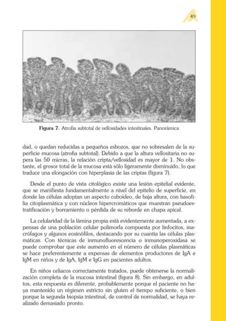 dad, o quedan reducidas a pequeños esbozos, que no sobresalen de la su-
perficie mucosa (atrofia subtotal). Debido a que la altura vellositaria no su-
pera las 50 micras, la relación cripta/vellosidad es mayor de 1. No obs-
tante, el grosor total de la mucosa está sólo ligeramente disminuido, lo que
traduce una elongación con hiperplasia de las criptas (figura 7).
Desde el punto de vista citológico existe una lesión epitelial evidente,
que se manifiesta fundamentalmente a nivel del epitelio de superficie, en
donde las células adoptan un aspecto cuboideo, de baja altura, con basofi-
lia citoplasmática y con núcleos hipercromáticos que muestran pseudoes-
tratificación y borramiento o pérdida de su reborde en chapa apical.
La celularidad de la lámina propia está evidentemente aumentada, a ex-
pensas de una población celular polimorfa compuesta por linfocitos, ma-
crófagos y algunos eosinófilos, destacando por su cuantía las células plas-
máticas. Con técnicas de inmunofluorescencia o inmunoperoxidasa se
puede comprobar que este aumento en el número de células plasmáticas
se hace preferentemente a expensas de elementos productores de IgA e
IgM en niños y de IgA, IgM e IgG en pacientes adultos.
En niños celíacos correctamente tratados, puede obtenerse la normali-
zación completa de la mucosa intestinal (figura 8). Sin embargo, en adul-
tos, esta respuesta es diferente, probablemente porque el paciente no ha-
ya mantenido un régimen estricto sin gluten el tiempo suficiente, o bien
porque la segunda biopsia intestinal, de control de normalidad, se haya re-
alizado demasiado pronto.
49
Figura 7. Atrofia subtotal de vellosidades intestinales. Panorámica
 