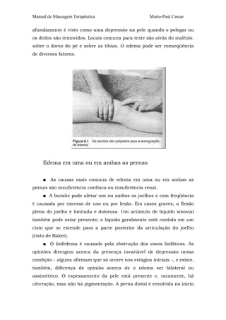 Manual de Massagem Terapêutica                       Mario-Paul Cassar

afundamento é visto como uma depressão na pele quando o polegar ou
os dedos são removidos. Locais comuns para teste são atrás do maléolo.
sobre o dorso do pé e sobre as tíbias. O edema pode ser conseqüência
de diversos fatores.




     Edema em uma ou em ambas as pernas


     ■   As causas mais comuns de edema em uma ou em ambas as
pernas são insuficiência cardíaca ou insuficiência renal.
     ■ A bursite pode afetar um ou ambos os joelhos e com freqüência
é causada por excesso de uso ou por lesão. Em casos graves, a flexão
plena do joelho é limitada e dolorosa. Um acúmulo de líquido sinovial
também pode estar presente; o líquido geralmente está contido em um
cisto que se estende para a parte posterior da articulação do joelho
(cisto de Baker).
     ■ O linfedema é causado pela obstrução dos vasos linfáticos. As
opiniões divergem acerca da presença invariável de depressão nessa
condição - alguns afirmam que só ocorre nos estágios iniciais -, e existe,
também, diferença de opinião acerca de o edema ser bilateral ou
assimétrico. O espessamento da pele está presente e, raramente, há
ulceração, mas não há pigmentação. A perna distal é envolvida no início
 