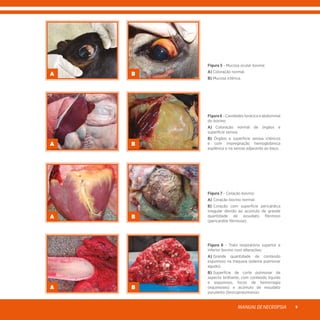 MANUALDENECROPSIA 9
Figura 5 - Mucosa ocular bovina:
A) Coloração normal.
B) Mucosa ictérica.
A B
Figura 6 - Cavidades torácica e abdominal
do bovino:
A) Coloração normal de órgãos e
superfície serosa.
B) Órgãos e superfície serosa ictéricos
e com impregnação hemoglobínica
esplênica e na serosa adjacente ao baço.
A B
Figura 7 - Coração bovino:
A)	Coração bovino normal.
B)	Coração com superfície pericárdica
irregular devido ao acúmulo de grande
quantidade de exsudato fibrinoso
(pericardite fibrinosa).
A B
Figura 8 - Trato respiratório superior e
inferior bovino com alterações:
A)	Grande quantidade de conteúdo
espumoso na traqueia (edema pulmonar
agudo).
B)	Superfície de corte pulmonar de
aspecto brilhante, com conteúdo líquido
e espumoso, focos de hemorragia
(equimoses) e acúmulo de exsudato
purulento (brocopneumonia).
A B
 