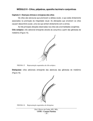 _____________________________________________________________________________________
Prof. Olicies da Cunha, MV, MSc.
UFPR – Campus Palotina
- 26 -
MÓDULO II - Cílios, pálpebras, aparelho lacrimal e conjuntivas
Capítulo 3 - Doenças clínicas e cirúrgicas dos cílios
Os cílios são estruturas que promovem a defesa ocular, e que estão diretamente
associados na promoção da integridade visual. As alterações que envolvem os cílios
causam desconforto ocular, uma vez que atritam diretamente com a córnea.
As três principais afecções observadas nos cílios são anormalidades congênitas.
Cílio ectópico: cílio adicional emergindo através da conjuntiva a partir das glândulas de
meibômio (Figura 15).
FIGURA 15 Representação esquemática de cílio ectópico.
Distiquíase: cílios adicionais emergindo das aberturas das glândulas de meibômio
(Figura 16).
FIGURA 16 Representação esquemática de distiquíase.
 