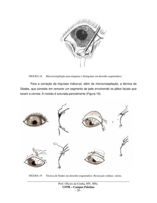 _____________________________________________________________________________________
Prof. Olicies da Cunha, MV, MSc.
UFPR – Campus Palotina
- 28 -
FIGURA 18 Microcrioepilação para triquíase e distiquíase em desenho esquemático.
Para a correção da triquíase indica-se, além da microcrioepilação, a técnica de
Stades, que consiste em remover um segmento de pele envolvendo os pêlos faciais que
tocam a córnea. A incisão é suturada parcialmente (Figura 19).
FIGURA 19 Técnica de Stades em desenho esquemático. Ressecção cutânea sutura.
 