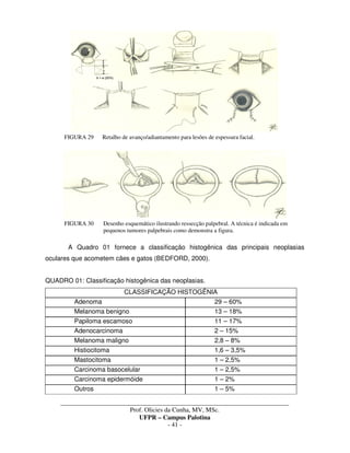 _____________________________________________________________________________________
Prof. Olicies da Cunha, MV, MSc.
UFPR – Campus Palotina
- 41 -
FIGURA 29 Retalho de avanço/adiantamento para lesões de espessura facial.
FIGURA 30 Desenho esquemático ilustrando ressecção palpebral. A técnica é indicada em
pequenos tumores palpebrais como demonstra a figura.
A Quadro 01 fornece a classificação histogênica das principais neoplasias
oculares que acometem cães e gatos (BEDFORD, 2000).
QUADRO 01: Classificação histogênica das neoplasias.
CLASSIFICAÇÃO HISTOGÊNIA
Adenoma 29 – 60%
Melanoma benigno 13 – 18%
Papiloma escamoso 11 – 17%
Adenocarcinoma 2 – 15%
Melanoma maligno 2,8 – 8%
Histiocitoma 1,6 – 3,5%
Mastocitoma 1 – 2,5%
Carcinoma basocelular 1 – 2,5%
Carcinoma epidermóide 1 – 2%
Outros 1 – 5%
 