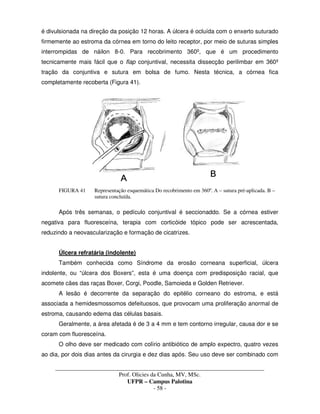 _____________________________________________________________________________________
Prof. Olicies da Cunha, MV, MSc.
UFPR – Campus Palotina
- 58 -
é divulsionada na direção da posição 12 horas. A úlcera é ocluída com o enxerto suturado
firmemente ao estroma da córnea em torno do leito receptor, por meio de suturas simples
interrompidas de náilon 8-0. Para recobrimento 360º, que é um procedimento
tecnicamente mais fácil que o flap conjuntival, necessita dissecção perilimbar em 360º
tração da conjuntiva e sutura em bolsa de fumo. Nesta técnica, a córnea fica
completamente recoberta (Figura 41).
FIGURA 41 Representação esquemática Do recobrimento em 360º. A – sutura pré-aplicada. B –
sutura concluída.
Após três semanas, o pedículo conjuntival é seccionaddo. Se a córnea estiver
negativa para fluoresceína, terapia com corticóide tópico pode ser acrescentada,
reduzindo a neovascularização e formação de cicatrizes.
Úlcera refratária (indolente)
Também conhecida como Síndrome da erosão corneana superficial, úlcera
indolente, ou “úlcera dos Boxers”, esta é uma doença com predisposição racial, que
acomete cães das raças Boxer, Corgi, Poodle, Samoieda e Golden Retriever.
A lesão é decorrente da separação do epitélio corneano do estroma, e está
associada a hemidesmossomos defeituosos, que provocam uma proliferação anormal de
estroma, causando edema das células basais.
Geralmente, a área afetada é de 3 a 4 mm e tem contorno irregular, causa dor e se
coram com fluoresceína.
O olho deve ser medicado com colírio antibiótico de amplo expectro, quatro vezes
ao dia, por dois dias antes da cirurgia e dez dias após. Seu uso deve ser combinado com
 