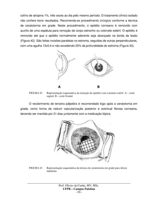 _____________________________________________________________________________________
Prof. Olicies da Cunha, MV, MSc.
UFPR – Campus Palotina
- 59 -
colírio de atropina 1%, três vezes ao dia pelo mesmo período. O tratamento clínico isolado
não confere bons resultados. Recomenda-se procedimento cirúrgico conforme a técnica
de ceratotomia em grade. Neste procedimento, o epitélio corneano é removido com
auxílio de uma espátula para remoção de corpo estranho ou cotonete estéril. O epitélio é
removido até que o epitélio normalmente aderente seja alcançado na borda da lesão
(Figura 42). São feitas incisões paralelas no estroma, seguidas de outras perpendiculares,
com uma agulha 13x0,4 e não excedendo 25% da profundidade do estroma (Figura 43).
FIGURA 42 Representação esquemática da remoção do epitélio com cotonete estéril. A – corte
sagital. B – corte frontal.
O recobrimento de terceira pálpebra é recomendado logo após a ceratotomia em
grade, como forma de reduzir vascularização posterior e eventual fibrose corneana,
devendo ser mantida por 21 dias juntamente com a medicação tópica.
FIGURA 43 Representação esquemática da técnica de ceratotomia em grade para úlcera
indolente.
 