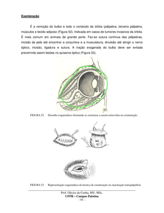 _____________________________________________________________________________________
Prof. Olicies da Cunha, MV, MSc.
UFPR – Campus Palotina
- 81 -
Exenteração
É a remoção do bulbo e todo o conteúdo da órbita (pálpebra, terceira pálpebra,
músculos e tecido adiposo (Figura 52). Indicada em casos de tumores invasivos da órbita.
É mais comum em animais de grande porte. Faz-se sutura contínua das pálpebras,
incisão da pele até encontrar a conjuntiva e a musculatura, divulsão até atingir o nervo
óptico, incisão, ligadura e sutura. A tração exagerada do bulbo deve ser evitada
prevenindo assim lesões no quiasma óptico (Figura 53).
FIGURA 52 Desenho esquemático ilustrando as estruturas a serem removidas na exenteração.
FIGURA 53 Representação esquemática da técnica de exenteração ou enucleação transpalpebral.
 