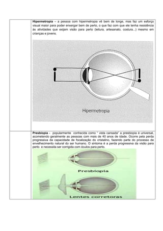 Hipermetropia – a pessoa com hipermetropia vê bem de longe, mas faz um esforço
visual maior para poder enxergar bem de perto, o que faz com que ele tenha resistência
às atividades que exijam visão para perto (leitura, artesanato, costura...) mesmo em
crianças e jovens.

Presbiopia - popularmente conhecida como “ vista cansada” a presbiopia é universal,
acometendo geralmente as pessoas com mais de 40 anos de idade. Ocorre pela perda
progressiva da capacidade de focalização do cristalino, fazendo parte do processo de
envelhecimento natural do ser humano. O sintoma é a perda progressiva da visão para
perto e necessita ser corrigida com óculos para perto.

 