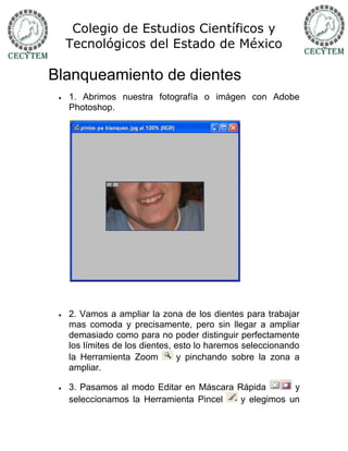 Colegio de Estudios Científicos y
     Tecnológicos del Estado de México

Blanqueamiento de dientes
    1. Abrimos nuestra fotografía o imágen con Adobe
     Photoshop.




    2. Vamos a ampliar la zona de los dientes para trabajar
     mas comoda y precisamente, pero sin llegar a ampliar
     demasiado como para no poder distinguir perfectamente
     los límites de los dientes, esto lo haremos seleccionando
     la Herramienta Zoom          y pinchando sobre la zona a
     ampliar.

    3. Pasamos al modo Editar en Máscara Rápida       y
     seleccionamos la Herramienta Pincel   y elegimos un
 
