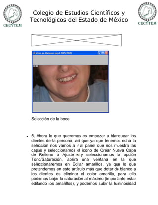Colegio de Estudios Científicos y
    Tecnológicos del Estado de México




    Selección de la boca



   5. Ahora lo que queremos es empezar a blanquear los
    dientes de la persona, asi que ya que tenemos echa la
    selección nos vamos a ir al panel que nos muestra las
    capas y seleccionamos el icono de Crear Nueva Capa
    de Relleno o Ajuste        y seleccionamos la opción
    Tono/Saturación, abrirá una ventana en la que
    seleccionaremos en Editar amarillos, ya que lo que
    pretendemos en este artículo más que dotar de blanco a
    los dientes es eliminar el color amarillo, para ello
    podemos bajar la saturación al máximo (importante estar
    editando los amarillos), y podemos subir la luminosidad
 