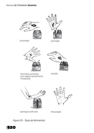 120
Manual de Primeiros Socorros
Figura 33 - Tipos de ferimentos
 