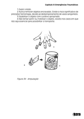 125
Capítulo III Emergências Traumáticas
1.Expor a lesão.
2.Nunca remover objetos encravados. Existe o risco significativo de
precipitar hemorragia, devido ao destamponamento de vasos sangüíneos.
3.Estabilizar o objeto com curativo apropriado.
4.Não tentar partir ou mobilizar o objeto, exceto nos casos em que
isto seja essencial para possibilitar o transporte.
Figura 34 - Amputação
 