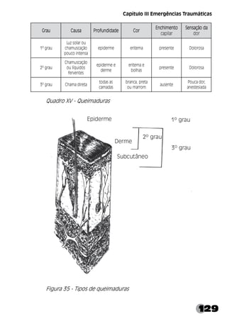 129
Capítulo III Emergências Traumáticas
Quadro XV - Queimaduras
Figura 35 - Tipos de queimaduras
u
a
r
G u
a
r
G u
a
r
G u
a
r
G u
a
r
G a
s
u
a
C a
s
u
a
C a
s
u
a
C a
s
u
a
C a
s
u
a
C e
d
a
d
i
d
n
u
f
o
r
P e
d
a
d
i
d
n
u
f
o
r
P e
d
a
d
i
d
n
u
f
o
r
P e
d
a
d
i
d
n
u
f
o
r
P e
d
a
d
i
d
n
u
f
o
r
P r
o
C r
o
C r
o
C r
o
C r
o
C
o
t
n
e
m
i
h
c
n
E o
t
n
e
m
i
h
c
n
E o
t
n
e
m
i
h
c
n
E o
t
n
e
m
i
h
c
n
E o
t
n
e
m
i
h
c
n
E
r
a
l
i
p
a
c
a
d
o
ã
ç
a
s
n
e
S a
d
o
ã
ç
a
s
n
e
S a
d
o
ã
ç
a
s
n
e
S a
d
o
ã
ç
a
s
n
e
S a
d
o
ã
ç
a
s
n
e
S
r
o
d
u
a
r
g
º
1
u
o
r
a
l
o
s
z
u
L
o
ã
ç
a
c
s
u
m
a
h
c
a
s
n
e
t
n
i
o
c
u
o
p
e
m
r
e
d
i
p
e a
m
e
t
i
r
e e
t
n
e
s
e
r
p a
s
o
r
o
l
o
D
u
a
r
g
º
2
o
ã
ç
a
c
s
u
m
a
h
C
s
o
d
i
u
q
í
l
u
o
s
e
t
n
e
v
r
e
f
e
e
m
r
e
d
i
p
e
e
m
r
e
d
e
a
m
e
t
i
r
e
s
a
h
l
o
b
e
t
n
e
s
e
r
p a
s
o
r
o
l
o
D
u
a
r
g
º
3 a
t
e
r
i
d
a
m
a
h
C
s
a
s
a
d
o
t
s
a
d
a
m
a
c
a
t
e
r
p
,
a
c
n
a
r
b
m
o
r
r
a
m
u
o
e
t
n
e
s
u
a
,
r
o
d
a
c
u
o
P
a
d
a
i
s
e
t
s
e
n
a
 