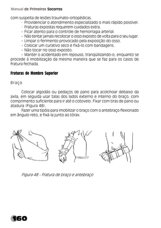 160
Manual de Primeiros Socorros
com suspeita de lesões traumato-ortopédicas.
· Providenciar o atendimento especializado o mais rápido possível.
· Fraturas expostas requerem cuidados extra.
­ Ficar atento para o controle de hemorragia arterial.
­ Não tentar jamais recolocar o osso exposto de volta para o seu lugar.
­ Limpar o ferimento provocado pela exposição do osso.
­ Colocar um curativo seco e fixá-lo com bandagens.
­ Não tocar no osso exposto.
­ Manter o acidentado em repouso, tranqüilizando-o, enquanto se
procede à imobilização da mesma maneira que se faz para os casos de
fratura fechada.
Fraturas de Membro Superior
Braço
Colocar algodão ou pedaços de pano para acolchoar debaixo da
axila, em seguida usar talas dos lados externo e interno do braço, com
comprimento suficiente para ir até o cotovelo. Fixar com tiras de pano ou
atadura (Figura 48).
Fazer uma tipóia para imobilizar o braço com o antebraço flexionado
em ângulo reto, e fixá-la junto ao tórax.
Figura 48 - Fratura de braço e antebraço
 