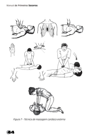 44
Manual de Primeiros Socorros
Figura 7 - Técnica de massagem cardíaca externa
 
