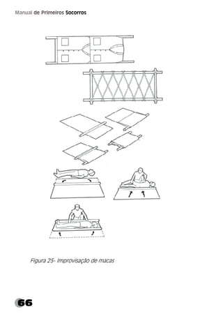 66
Manual de Primeiros Socorros
Figura 25- Improvisação de macas
 