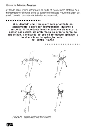 72
Manual de Primeiros Socorros
evitando assim maior sofrimento da parte sã do membro afetado. Se a
hemorragia for contida, deve-se deixar o torniquete frouxo no lugar, de
modo que ele possa ser reapertado caso necessário.
O acidentado com torniquete tem prioridade no
atendimento e deve ser acompanhada durante o
transporte. É importante lembrar também de marcar e
anotar por escrito, de preferência no próprio corpo do
acidentado, a indicação de que há torniquete aplicado, o
local e a hora da aplicação, assim:
TQ BRAÇO 10:15h
Figura 26 - Como fazer um torniquete
○ ○ ○ ○ ○ ○ ○ ○ ○ ○ ○ ○ ○ ○ ○ ○ ○ ○ ○ ○
○ ○ ○ ○ ○ ○ ○ ○ ○ ○ ○ ○ ○ ○ ○ ○ ○ ○ ○ ○
 