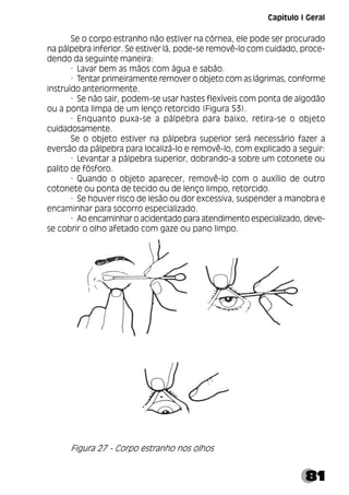 81
Se o corpo estranho não estiver na córnea, ele pode ser procurado
na pálpebra inferior. Se estiver lá, pode-se removê-lo com cuidado, proce-
dendo da seguinte maneira:
· Lavar bem as mãos com água e sabão.
· Tentar primeiramente remover o objeto com as lágrimas, conforme
instruído anteriormente.
· Se não sair, podem-se usar hastes flexíveis com ponta de algodão
ou a ponta limpa de um lenço retorcido (Figura 53).
· Enquanto puxa-se a pálpebra para baixo, retira-se o objeto
cuidadosamente.
Se o objeto estiver na pálpebra superior será necessário fazer a
eversão da pálpebra para localizá-lo e removê-lo, com explicado a seguir:
· Levantar a pálpebra superior, dobrando-a sobre um cotonete ou
palito de fósforo.
· Quando o objeto aparecer, removê-lo com o auxílio de outro
cotonete ou ponta de tecido ou de lenço limpo, retorcido.
· Se houver risco de lesão ou dor excessiva, suspender a manobra e
encaminhar para socorro especializado.
· Ao encaminhar o acidentado para atendimento especializado, deve-
se cobrir o olho afetado com gaze ou pano limpo.
Figura 27 - Corpo estranho nos olhos
Capítulo I Geral
 