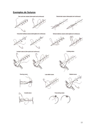 Exemplos de Suturas
15
 