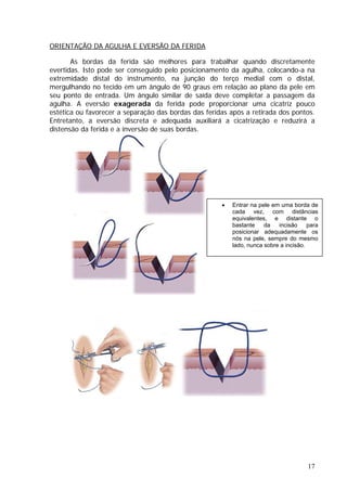 ORIENTAÇÃO DA AGULHA E EVERSÃO DA FERIDA
As bordas da ferida são melhores para trabalhar quando discretamente
evertidas. Isto pode ser conseguido pelo posicionamento da agulha, colocando-a na
extremidade distal do instrumento, na junção do terço medial com o distal,
mergulhando no tecido em um ângulo de 90 graus em relação ao plano da pele em
seu ponto de entrada. Um ângulo similar de saída deve completar a passagem da
agulha. A eversão exagerada da ferida pode proporcionar uma cicatriz pouco
estética ou favorecer a separação das bordas das feridas após a retirada dos pontos.
Entretanto, a eversão discreta e adequada auxiliará a cicatrização e reduzirá a
distensão da ferida e a inversão de suas bordas.
• Entrar na pele em uma borda de
cada vez, com distâncias
equivalentes, e distante o
bastante da incisão para
posicionar adequadamente os
nós na pele, sempre do mesmo
lado, nunca sobre a incisão.
17
 