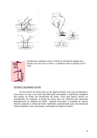 Geralmente a distância entre o orifício de entrada da agulha até a
incisão é de cerca de 4 a 5mm, e a distância entre os pontos é de 5-
7mm
SUTURA E SEGURANÇA DO NÓ
Os nós devem ser firmes para ser de alguma eficácia. Isto está em oposição a
uma sutura em que o nó muito apertado pode estrangular o suprimento sangüíneo
dos bordos da ferida. No fechamento da ferida, esses dois fatores devem ser
considerados em conjunto. A tensão da sutura deve ser suficiente para aproximar
delicadamente as margens da ferida. Quando necessário, o emprego de suturas
internas reduzirão a tensão da ferida, facilitando a aproximação suave das bordas da
ferida auxiliando a boa cicatrização e otimização do aspecto estético.
18
 