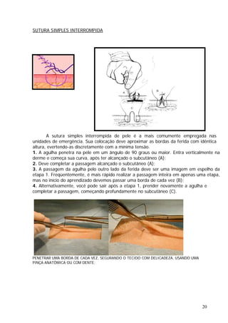 SUTURA SIMPLES INTERROMPIDA
A sutura simples interrompida de pele é a mais comumente empregada nas
unidades de emergência. Sua colocação deve aproximar as bordas da ferida com idêntica
altura, evertendo-as discretamente com a mínima tensão.
1. A agulha penetra na pele em um ângulo de 90 graus ou maior. Entra verticalmente na
derme e começa sua curva, após ter alcançado o subcutâneo (A);
2. Deve completar a passagem alcançado o subcutâneo (A);
3. A passagem da agulha pelo outro lado da ferida deve ser uma imagem em espelho da
etapa 1. Freqüentemente, é mais rápido realizar a passagem inteira em apenas uma etapa,
mas no início do aprendizado devemos passar uma borda de cada vez (B);
4. Alternativamente, você pode sair após a etapa 1, prender novamente a agulha e
completar a passagem, começando profundamente no subcutâneo (C).
PENETRAR UMA BORDA DE CADA VEZ, SEGURANDO O TECIDO COM DELICADEZA, USANDO UMA
PINÇA ANATÔMICA OU COM DENTE;
20
 