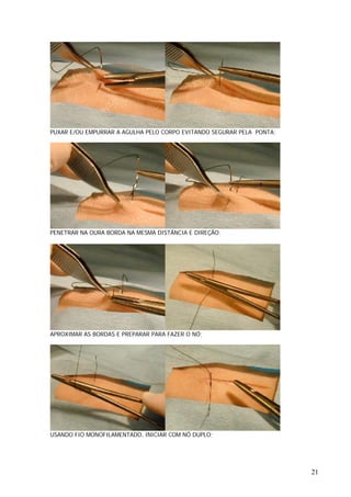 PUXAR E/OU EMPURRAR A AGULHA PELO CORPO EVITANDO SEGURAR PELA PONTA;
PENETRAR NA OURA BORDA NA MESMA DISTÂNCIA E DIREÇÃO;
APROXIMAR AS BORDAS E PREPARAR PARA FAZER O NÓ;
USANDO FIO MONOFILAMENTADO, INICIAR COM NÓ DUPLO;
21
 