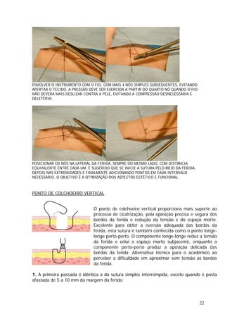 ENVOLVER O INSTRUMENTO COM O FIO, COM MAIS 4 NÓS SIMPLES SUBSEQUENTES, EVITANDO
APERTAR O TECIDO. A PRESSÃO DEVE SER EXERCIDA A PARTIR DO QUARTO NÓ QUANDO O FIO
NÃO DEVERÁ MAIS DESLIZAR CONTRA A PELE, EVITANDO A COMPRESSÃO DESNECESSÁRIA E
DELETÉRIA;
POSICIONAR OS NÓS NA LATERAL DA FERIDA, SEMPRE DO MESMO LADO, COM DISTÂNCIA
EQUIVALENTE ENTRE CADA UM. É SUGERIDO QUE SE INICIE A SUTURA PELO MEIO DA FERIDA,
DEPOIS NAS EXTREMIDADES E FINALMENTE ADICIONANDO PONTOS EM CADA INTERVALO
NECESSÁRIO. O OBJETIVO É A OTIMIZAÇÃO DOS ASPECTOS ESTÉTICO E FUNCIONAL.
PONTO DE COLCHOEIRO VERTICAL
O ponto de colchoeiro vertical proporciona mais suporte ao
processo de cicatrização, pela oposição precisa e segura dos
bordos da ferida e redução da tensão e do espaço morto.
Excelente para obter a eversão adequada das bordas da
ferida, esta sutura é também conhecida como o ponto longe-
longe perto-perto. O componente longe-longe reduz a tensão
da ferida e oclui o espaço morto subjacente, enquanto o
componente perto-perto produz a aposição delicada das
bordas da ferida. Alternativa técnica para o acadêmico ao
perceber a dificuldade em aproximar sem tensão as bordas
da ferida.
1. A primeira passada é idêntica a da sutura simples interrompida, exceto quando é posta
afastada de 5 a 10 mm da margem da ferida;
22
 