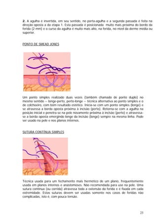 2. A agulha é invertida, em seu sentido, no porta-agulha e a segunda passada é feita na
direção oposta a da etapa 1. Esta passada é posicionada muito mais próxima do bordo da
ferida (2 mm) e o curso da agulha é muito mais alto, na ferida, no nível da derme média ou
superior.
PONTO DE SMEAD JONES
Um ponto simples realizado duas vezes (também chamado de ponto duplo) no
mesmo sentido -- longe-perto, perto-longe -- técnica alternativa ao ponto simples e o
de colchoeiro, com bom resultado estético. Inicia-se com um ponto simples (longe) e
se atravessa a borda oposta próxima à incisão (perto). Retorna-se com a agulha na
posição inicial e penetra-se na pele novamente próxima à incisão (perto) e atravessa-
se a borda oposta emergindo longe da incisão (longe) sempre na mesma linha. Pode
ser usado na pele e nos planos internos.
SUTURA CONTÍNUA SIMPLES
Técnica usada para um fechamento mais hermético de um plano, frequentemente
usada em planos internos e anastomoses. Não recomendada para uso na pele. Uma
sutura contínua (ou corrida) atravessa toda a extensão da ferida e é fixada em cada
extremidade. Estas suturas devem ser usadas somente nos casos de feridas não
complicadas, isto é, com pouca tensão.
23
 