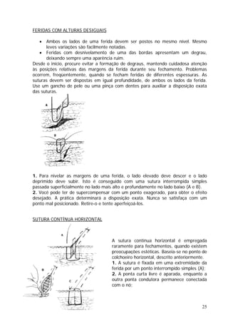 FERIDAS COM ALTURAS DESIGUAIS
ser postos no mesmo nível. Mesmo
das bordas apresentam um degrau,
ho de pele ou uma pinça com dentes para auxiliar a disposição exata
das suturas.
• Ambos os lados de uma ferida devem
leves variações são facilmente notadas.
• Feridas com desnivelamento de uma
deixando sempre uma aparência ruim.
Desde o início, procure evitar a formação de degraus, mantendo cuidadosa atenção
às posições relativas das margens da ferida durante seu fechamento. Problemas
ocorrem, freqüentemente, quando se fecham feridas de diferentes espessuras. As
suturas devem ser dispostas em igual profundidade, de ambos os lados da ferida.
Use um ganc
1. Para nivelar as margens de uma ferida, o lado elevado deve descer e o lado
deprimido deve subir. Isto é conseguido com uma sutura interrompida simples
Nunca se satisfaça com um
onto mal posicionado. Retire-o e tente aperfeiçoá-los.
SUTURA CONTÍNUA HORIZONTAL
passada superficialmente no lado mais alto e profundamente no lado baixo (A e B).
2. Você pode ter de supercompensar com um ponto exagerado, para obter o efeito
desejado. A prática determinará a disposição exata.
p
a condutora permanece conectada
A sutura contínua horizontal é empregada
raramente para fechamentos, quando existem
preocupações estéticas. Baseia-se no ponto de
colchoeiro horizontal, descrito anteriormente.
1. A sutura é fixada em uma extremidade da
ferida por um ponto interrompido simples (A);
2. A ponta curta livre é aparada, enquanto a
outra pont
com o nó;
25
 