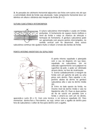 3. As passadas de colchoeiro horizontal adjacentes são feitas sem outros nós até que
a extremidade distal da ferida seja alcançada. Cada componente horizontal deve ser
êntico em altura e distância das margens da ferida (B e C).
UTURA SUBCUTÂNEA INTERROMPIDA
id
S
tura
ubcutânea contínua não ajudará muito a reduzir a tensão das bordas da ferida.
ONTO INTERNO INVERTIDO OU SEPULTADO
A sutura subcutânea interrompida é usada em feridas
profundas. O fechamento de espaço morto melhora o
nível da ferida e reduz as chances de infecção e
formação de hematoma. A gordura subcutânea pode
ser aproximada com poucos pontos interrompidos, no
sentido vertical com fio absorvível. Uma su
s
P
o
tânea alta e saia na derme média
gulha de dentro para
ra do subcutâneo e voltar de fora para dentro com a agulha.
O ponto interno sepultado é planejado
com o seu nó disposto em sua base,
sepultado no subcutâneo. Um nó
colocado superiormente será palpável na
superfície da pele, e pode ser eliminad
através desta, na fase de cicatrização.
1. Everta cuidadosamente a margem da
ferida com um gancho de pele ou uma
pinça com dentes. Para sepultar o nó,
penetre abaixo da derme na gordura
subcu
(A);
2. Entre no lado oposto da ferida, no
mesmo nível da derme média e saia na
hipoderme alta (1). Puxe as duas pontas
do fio de sutura em paralelo com a
ferida e amarre-as com um nó direito,
aparando-o curto (B e C). Com esta técnica, o nó torna-se sepultado (2). Para
memorizar: dentro-fora e fora-dentro, ou seja, entrar com a a
fo
26
 