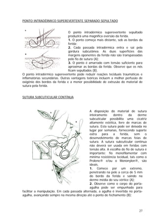 PONTO INTRADÉRMICO SUPEREVERTENTE SEPARADO SEPULTADO
pultado
nto começa mais distante, sob as bordas da
ferida não são transpassadas
da ferida. Observe que os nós
s da ferida e a menor possibilidade de extrusão do material de
utura pela ferida.
UTURA SUBCUTICULAR CONTÍNUA
O ponto intradérmico superevertente se
produzirá uma magnífica eversão da ferida.
1. O po
ferida;
2. Cada passada intradérmica entra e sai pela
gordura subcutânea. As duas superfícies das
margens oponentes da
pelo fio de sutura (A);
3. O ponto é amarrado com tensão suficiente para
aproximar as bordas
ficam sepultados (B).
O ponto intradérmico superevertente pode reduzir reações teciduais traumáticas e
inflamatórias secundárias. Outras vantagens teóricas incluem a melhor perfusão de
oxigênio dos bordo
s
S
® e/ou o Mononylon®, são
saindo na
porta-
A disposição do material de sutura
inteiramente dentro da derme
subcuticular possibilita uma cicatriz
altamente estética, livre de marcas de
sutura. Esta sutura pode ser deixada no
lugar por semanas, fornecendo suporte
extra para a ferida, sem o
desenvolvimento de marcas feias de
sutura. A sutura subcuticular contínua
não deverá ser usada em feridas com
tensão alta. A escolha do fio de sutura é
importante: fio monofilamentar com
mínima resistência tecidual, tais como o
Prolene
ideais.
1. Comece por um extremo,
penetrando na pele a cerca de 5 mm
do bordo da ferida e
derme média do seu vértice (A);
2. Observe como o corpo do porta-
agulha pode ser empunhado para
facilitar a manipulação. Em cada passada alternada, a agulha é invertida no
agulha, avançando sempre na mesma direção até o ponto de fechamento (B);
27
 