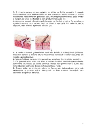 3. A primeira passada começa próximo ao vértice da ferida. A agulha é passada
horizontalmente entre a derme média e a alta, e o mesmo nível é mantido por todo o
m frente à primeira. Em vez disso, a
gulha é recuada cerca de um terço da distância avançada. Em todos os outros
spectos, ela é idêntica à primeira passada (D);
fechamento. Note como um gancho de pele, ou uma pinça com dentes, pode everter
a margem da ferida e estabilizá-la, sem produzir maceração (C);
4. A segunda passada não começa diretamente e
a
a
5. A ferida é fechada gradualmente com uma terceira e subseqüentes passadas,
superfície (externalizada)
u faça os nós independentes para cada
xtremidade e pode-se aplicar Micropore® ou fitas adesivas Steristrip® para
stabilizar a superfície da ferida.
mantendo sempre a mesma altura intradérmica horizontal e sempre recuando em
relação à passada prévia;
6. Saia da ferida do mesmo modo que entrou, através da derme média, no vértice;
7. Em qualquer ferida maior que 3 cm, a sutura é trazida à
como uma só passada de sutura contínua simples. Isto permite que a sutura seja
removida mais facilmente depois do fechamento da ferida;
8. Amarre ambas as pontas da sutura, o
e
e
28
 