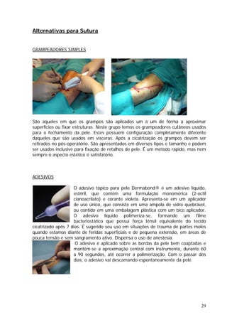 Alternativas para Sutura
GRAMPEADORES SIMPLES
ados em diversos tipos e tamanho e podem
er usados inclusive para fixação de retalhos de pele. É um método rápido, mas nem
empre o aspecto estético é satisfatório.
ADESIVOS
São aqueles em que os grampos são aplicados um a um de forma a aproximar
superfícies ou fixar estruturas. Neste grupo temos os grampeadores cutâneos usados
para o fechamento da pele. Estes possuem configuração completamente diferente
daqueles que são usados em vísceras. Após a cicatrização os grampos devem ser
retirados no pós-operatório. São apresent
s
s
quando estamos di
pouca tensão e sem
durante 60
desivo vai descamando espontaneamente da pele.
O adesivo tópico para pele Dermabond® é um adesivo líquido,
estéril, que contém uma formulação monomérica (2-octil
cianoacrilato) e corante violeta. Apresenta-se em um aplicador
de uso único, que consiste em uma ampola de vidro quebrável,
ou contido em uma embalagem plástica com um bico aplicador.
O adesivo líquido polimeriza-se, formando um filme
bacteriostático que possui força tênsil equivalente do tecido
cicatrizado após 7 dias. É sugerido seu uso em situações de trauma de partes moles
ante de feridas superficiais e de pequena extensão, em áreas de
sangramento ativo. Dispensa o uso de anestesia.
O adesivo é aplicado sobre as bordas da pele bem coaptadas e
mantém-se a aproximação central com instrumento,
a 90 segundos, até ocorrer a polimerização. Com o passar dos
dias, o a
29
 