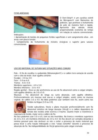 FITAS ADESIVAS
O Steri-Strip® é um curativo estéril
poliéster, que promove o fechamento
de Micropore® com filamentos de
de pele de maneira fácil e rápida.
economia de tempo
em relação às suturas convencionais.
dicações:
Aproximação de bordas de pequenas feridas superficiais e sem sangramento ativo , em
reas com pouca tensão;
Complemento do fechamento de incisões cirúrgicas e suporte para suturas
onvencionais.
DE SUTURA NAS SITUAÇÕES MAIS COMUNS
Apresenta boa adesão inicial,
proporcionando
In
•
á
•
c
USO DO MATERIAL
amida (Mmononylon®) e o calibre terá variação de acordo
o
Região genital - Deve-se dar preferência ao uso de fio absorvível como o catgut simples,
l
F
e
usar também este fio, assim como nas
istência e
será o calibre do fio.
face podemos usar 5.0 e 6.0, com os nós invertidos. No tronco e membros superiores
o o
ue
de
Pele - O fio de escolha é a poli
com o sítio da lesão. Usar agulha cortante;
Escalpo - 2.0 ou 3.0;
Face - 5.0 ou 6.0;
Tronco - 4.0 e 5.0;
Membros superiores - 4.0 e 5.0;
res - 3.0 e 4.0;
Membro inferi
com agulha ci
Mucosas -
Preferencialm
indrica, de 3.0 a 5.0;
io absorvível de longa ou curta absorção, com agulha cilíndrica.
nte em mucosa oral usa-se o catgut simples, assim como na mucosa
vaginal, de calibre 3.0 a 4.0. No lábio podemos
feridas na língua (3.0 ou 2.0)
Tecido subcutâneo, fáscia e plano muscular preferencialmente com fio
absorvível sintético de longa duração (Vicryl) e o calibre dependerá da
tensão dos tecidos onde ocorreu o trauma. Quanto maior a res
espessura do tecido, maior
Na
de 3.0 a 4.0, em membros inferiores de 2.0 a 4.0. Os fios devem ser cortados deixand
mínimo possível para não desfazer os nós e evitar a presença de muito material q
possa levar à uma reação indesejada a este “corpo estranho” durante o processo
absorção do fio. Na indisponibilidade do Vicryl optaremos pelo catgut cromado.
30
 