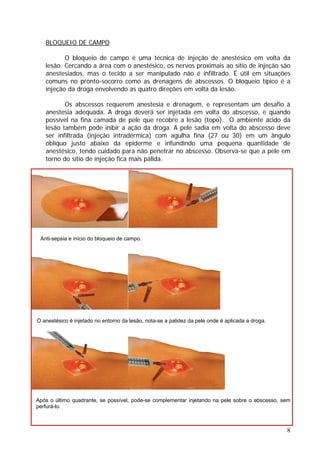 BLOQUEIO DE CAMPO
O bloqueio de campo é uma técnica de injeção de anestésico em volta da
lesão. Cercando a área com o anestésico, os nervos proximais ao sítio de injeção são
anestesiados, mas o tecido a ser manipulado não é infiltrado. É útil em situações
comuns no pronto-socorro como as drenagens de abscessos. O bloqueio típico é a
injeção da droga envolvendo as quatro direções em volta da lesão.
Os abscessos requerem anestesia e drenagem, e representam um desafio à
anestesia adequada. A droga deverá ser injetada em volta do abscesso, e quando
possível na fina camada de pele que recobre a lesão (topo). O ambiente ácido da
lesão também pode inibir a ação da droga. A pele sadia em volta do abscesso deve
ser infiltrada (injeção intradérmica) com agulha fina (27 ou 30) em um ângulo
oblíquo justo abaixo da epiderme e infundindo uma pequena quantidade de
anestésico, tendo cuidado para não penetrar no abscesso. Observa-se que a pele em
torno do sítio de injeção fica mais pálida.
Anti-sepsia e início do bloqueio de campo.
O anestésico é injetado no entorno da lesão, nota-se a palidez da pele onde é aplicada a droga.
8
Após o último quadrante, se possível, pode-se complementar injetando na pele sobre o abscesso, sem
perfurá-lo.
 