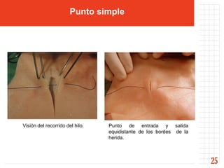 Punto simple




Visión del recorrido del hilo.   Punto de entrada y salida
                                 equidistante de los bordes de la
                                 herida.



                                                                    25
 