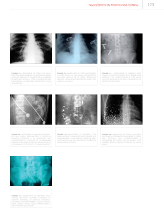 DIAGNÓSTICO EN TOXICOLOGÍA CLÍNICA
FIGURA 11.- RADIOGRAFÍA DE TÓRAX CON MÚLTI-
PLES PEQUEÑAS IMÁGENES DE DENSIDAD METÁLICA
CORRESPONDIENTES A UN EMBOLISMO PULMONAR
DE MERCURIO METÁLICO, TRAS LA ADMINISTRACIÓN
INTRAVENOSA DE MERCURIO PROCEDENTE DE UN
TERMÓMETRO.
FIGURA 12.- RADIOGRAFÍA DE TÓRAX MOSTRANDO
LA PARTE DISTAL DE UNA SONDA NASOGÁSTRICA
(FLECHAS) UBICADA EN EL ÁRBOL BRONQUIAL
DERECHO. INICIA BRONCOASPIRACIÓN BASAL POR
LAVADOS CON AGUA.
FIGURA 13.- RADIOGRAFÍA DE ABDOMEN MOS-
TRANDO 3 CUERPOS EXTRAÑOS EN EL HEMIABDOMEN
DERECHO, QUE CORRESPONDEN A PILAS INGERI-
DAS POR UN VARÓN DE 34 AÑOS CONFINADO EN UN
CENTRO PENITENCIARIO.
FIGURA 14.- RADIOGRAFÍA DE ABDOMEN MOSTRAN-
DO UNA SONDA NASOGÁSTRICA Y MÚLTIPLES
CUERPOS EXTRAÑOS A SU ALREDEDOR QUE
CORRESPONDEN A PASTILLAS DE CLOMIPRAMINA
INGERIDAS CON ÁNIMO SUICIDA EN UNA MUJER DE 22
AÑOS (IMAGEN CORTESÍA DEL DR. XAVIER BALANZÓ).
FIGURA 15.-RADIOGRAFÍA DE ABDOMEN, CON
GRAN CANTIDAD DE IMÁGENES RADIO-DENSAS QUE
CORRESPONDEN A UNA INGESTA MASIVA DE MER-
CURIO METÁLICA EN UNA TENTATIVA DE SUICIDIO DE
UNA MUJER DE 65 AÑOS.
FIGURA 16.- RADIOGRAFÍA DE TÓRAX Y ABDOMEN,
MOSTRANDO CENTENARES DE IMÁGENES DE DENSI-
DAD METÁLICA, QUE CORRESPONDEN A
PERDIGONES DE PLOMO POR UN DISPARO. ESTE
HOMBRE TIENE UN RIESGO POTENCIAL DE SATUR-
NISMO.
FIGURA 17.- RADIOGRAFÍA DE ABDOMEN, MOS-
TRANDO MÚLTIPLES CUERPOS EXTRAÑOS DE
MEDIANA DENSIDAD, DE ASPECTO CILÍNDRICO,
OCUPANDO MAYORITARIAMENTE COLON DESCEN-
DENTE, SIGMA Y RECTO, Y QUE CORRESPONDEN A
BODY-PACKERS DE COCAÍNA.
123
 