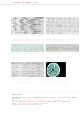 124 DIAGNÓSTICO EN TOXICOLOGÍA CLÍNICA
FIGURA 18.- ECG MOSTRANDO UN QRS ANCHO Y UN QT LARGO EN EL TRANS-
CURSO DE UNA INTOXICACIÓN POR AMITRIPTILINA EN UNA MUJER JOVEN.
FIGURA 19.- ECG CON UN BLOQUEO AURÍCULO-VENTRICULAR COMPLETO EN
UNA INTOXICACIÓN CRÓNICA POR DIGOXINA.
FIGURA 20.- ECG CON BRADICARDIA SINUSAL TRAS UNA INTOXICACIÓN CON EL
HERBICIDA GLUFOSINATO.
FIGURA 21.- ECG CON UNA TAQUICARDIA VENTRICULAR EN FORMA DE TORSADAS
DE POINTES, POR UNA INTOXICACIÓN AGUDA POR COCAÍNA.
FIGURA 22.- ECG MOSTRANDO UN INFARTO AGUDO DE MIOCARDIO TRAS UN
CONSUMO RECREATIVO DE COCAÍNA EN UN TRANSEXUAL.
FIGURA 23.- TC CRANEAL MOSTRANDO UN
HEMATOMA FRONTAL, EN UN VARÓN CON UNA
INTOXICACIÓN ALCOHÓLICA AGUDA DE EVOLU-
CIÓN TÓRPIDA.
BIBLIOGRAFÍA
Flomenbaum NE, Goldfrank LR, Hoffman RS, Howland MA, Lewin NA, Nelson LS. Goldfrank’s. TOXICOLOGIC EMERGENCIES. McGraw-Hill,
New York, 2006.
Danel V, Mégarbane B. URGENCES TOXICOLOGIQUES DE L’ADULTE. Arnette, Rueil-Malmaison, 2009.
Bryson PD. COMPREHENSIVE REVIEW IN TOXICOLOGY FOR EMERGENCY CLINICIANS. Taylor & Francis, Washington, 1996.
Holstege CP, Kirk MA. MEDICAL TOXICOLOGY. Saunders, Philadelphia, 2007.
Descotes J. HUMAN TOXICOLOGY. Elsevier, Amsterdam, 1996.
 