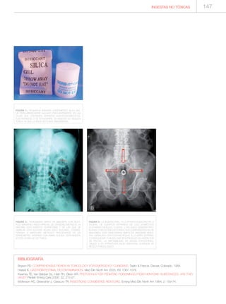 BIBLIOGRAFÍA
Bryson PD. COMPREHENSIVE REVIEW IN TOXICOLOGY FOR EMERGENCY CLINICIANS. Taylor & Francis, Denver, Colorado, 1984.
Heaed K. GASTROINTESTINAL DECONTAMINATION. Med Clin North Am 2005; 89: 1067-1078.
Kearney TE, Van Bebber SL, Hiatt PH, Olson KR. PROTOCOLS FOR PEDIATRIC POISONINGS FROM NONTOXIC SUBSTANCES: ARE THEY
VALID? Pediatr Emerg Care 2006; 22: 215-21.
Mofenson HC, Greensher J, Caraccio TR. INGESTIONS CONSIDERED NONTOXIC. Emerg Med Clin North Am 1984; 2: 159-74.
INGESTAS NO TÓXICAS 147
FIGURA 1.- PEQUEÑOS ENVASES CONTENIENDO SILICA GEL,
UN DESHUMIDIFICADOR HALLADO FRECUENTEMENTE EN LAS
CAJAS QUE CONTIENEN APARATOS ELECTRODOMÉSTICOS,
ELECTRÓNICOS O DE FOTOGRAFÍA. SU INGESTA NO RESULTA
TÓXICA YA QUE LA SÍLICE NO PUEDE ABSORBERSE.
FIGURA 2.- RADIOGRAFIA SIMPLE DE ABDOMEN CON MULTI-
PLES IMÁGENES RADIO-OPACAS, DE DENSIDAD METÁLICA, LA
MAYORIA CON ASPECTO PUNTIFORME Y DE LAS QUE SE
SEÑALAN CON FLECHAS ROJAS SÓLO ALGUNAS. CORRES-
PONDEN A MERCURIO METÁLICO PROCEDENTE DE UN
TERMÓMETRO, INGERIDO CON ÁNIMO SUICIDA. ESTA INGESTA
(A ESTA DOSIS) NO ES TÓXICA.
FIGURA 3.- LA INGESTA ORAL, O LA INTRODUCCIÓN RECTAL O
VAGINAL DE CUERPOS EXTRAÑOS DE USO DOMÉSTICO
(CUCHARAS, MUELLES, CLAVOS…), NO SUELE GENERAR PRO-
BLEMAS TOXICOLÓGICOS PORQUE SUS COMPONENTES NO SE
ABSORBEN. ESTA RADIOGRAFIA SIMPLE DE ABDOMEN MUES-
TRA –SEÑALADO CON FLECHAS ROJAS- EL CUERPO EXTRAÑO
(“CONSOLADOR” O DILDO) QUE SE INTRODUJO UN VARÓN POR
VÍA RECTAL. LA IMPOSIBILIDAD DE SALIDA ESPONTÁNEA,
OBLIGÓ A SU EXTRACCIÓN BAJO ANESTESIA. AUSENCIA DE
RIESGO TOXICOLÓGICO.
 