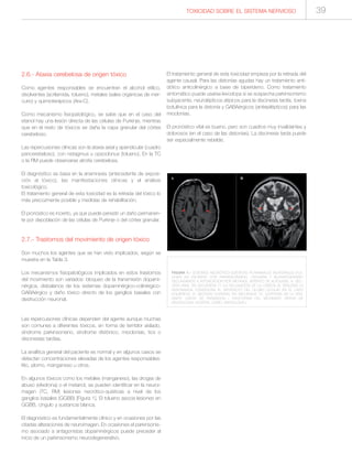 2.6.- Ataxia cerebelosa de origen tóxico
Como agentes responsables se encuentran el alcohol etílico,
disolventes (acrilamida, tolueno), metales (sales orgánicas de mer-
curio) y quimioterápicos (Ara-C).
Como mecanismo fisiopatológico, se sabe que en el caso del
etanol hay una lesión directa de las células de Purkinje, mientras
que en el resto de tóxicos se daña la capa granular del córtex
cerebeloso.
Las repercusiones clínicas son la ataxia axial y apendicular (cuadro
pancerebeloso), con nistagmus u opsoclonus (tolueno). En la TC
o la RM puede observarse atrofia cerebelosa.
El diagnóstico se basa en la anamnesis (antecedente de exposi-
ción al tóxico), las manifestaciones clínicas y el análisis
toxicológico.
El tratamiento general de esta toxicidad es la retirada del tóxico lo
más precozmente posible y medidas de rehabilitación.
El pronóstico es incierto, ya que puede persistir un daño permanen-
te por depoblación de las células de Purkinje o del córtex granular.
2.7.- Trastornos del movimiento de origen tóxico
Son muchos los agentes que se han visto implicados, según se
muestra en la Tabla 3.
Los mecanismos fisiopatológicos implicados en estos trastornos
del movimiento son variados: bloqueo de la transmisión dopami-
nérgica, disbalance de los sistemas dopaminérgico-colinérgico-
GABAérgico y daño tóxico directo de los ganglios basales con
destrucción neuronal.
Las repercusiones clínicas dependen del agente aunque muchas
son comunes a diferentes tóxicos, en forma de temblor aislado,
síndrome parkinsoniano, síndrome distónico, mioclonias, tics o
discinesias tardías.
La analítica general del paciente es normal y en algunos casos se
detectan concentraciones elevadas de los agentes responsables:
litio, plomo, manganeso u otros.
En algunos tóxicos como los metales (manganeso), las drogas de
abuso (efedrona) o el metanol, se pueden identificar en la neuroi-
magen (TC, RM) lesiones necrótico-quísticas a nivel de los
ganglios basales (GGBB) [Figura 1]. El tolueno asocia lesiones en
GGBB, cíngulo y sustancia blanca.
El diagnóstico es fundamentalmente clínico y en ocasiones por las
citadas alteraciones de neuroimagen. En ocasiones el parkinsonis-
mo asociado a antagonistas dopaminérgicos puede preceder al
inicio de un parkinsonismo neurodegenerativo.
El tratamiento general de esta toxicidad empieza por la retirada del
agente causal. Para las distonías agudas hay un tratamiento anti-
dótico anticolinérgico a base de biperideno. Como tratamiento
sintomático puede usarse levodopa si se sospecha parkinsonismo
subyacente, neurolépticos atípicos para la discinesia tardía, toxina
botulínica para la distonía y GABAérgicos (antiepilépticos) para las
mioclonias.
El pronóstico vital es bueno, pero son cuadros muy invalidantes y
dolorosos (en el caso de las distonías). La discinesia tarda puede
ser especialmente rebelde.
FIGURA 1.- LESIONES NECRÓTICO-QUÍSTICAS PUTAMINALES BILATERALES (FLE-
CHAS) EN PACIENTE CON PARKINSONISMO, CEGUERA Y BLEFAROSPASMO
SECUNDARIOS A INTOXICACIÓN POR METANOL (INTENTO DE AUTOLISIS). A: SEC-
CIÓN AXIAL EN SECUENCIA T1 (LA INCLINACIÓN DE LA CABEZA AL REALIZAR LA
RESONANCIA CONDICIONA EL ARTEFACTO DEL GLOBO OCULAR EN EL LADO
IZQUIERDO); B: SECCIÓN CORONAL EN SECUENCIA T2. [CORTESÍA DE LA DRA.
MARTÍ, UNITAT DE PARKINSON I TRASTORNS DEL MOVIMENT, SERVEI DE
NEUROLOGIA, HOSPITAL CLÍNIC, BARCELONA.]
TOXICIDAD SOBRE EL SISTEMA NERVIOSO 39
 