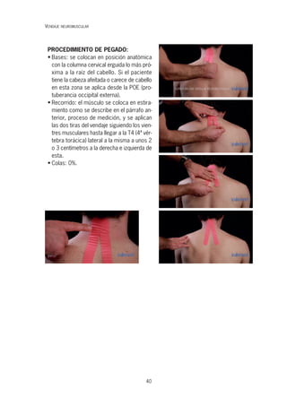 40
PROCEDIMIENTO DE PEGADO:
• Bases: se colocan en posición anatómica
con la columna cervical erguida lo más pró-
xima a la raíz del cabello. Si el paciente
tiene la cabeza afeitada o carece de cabello
en esta zona se aplica desde la POE (pro-
tuberancia occipital externa).
• Recorrido: el músculo se coloca en estira-
miento como se describe en el párrafo an-
terior, proceso de medición, y se aplican
las dos tiras del vendaje siguiendo los vien-
tres musculares hasta llegar a la T4 (4ª vér-
tebra torácica) lateral a la misma a unos 2
o 3 centímetros a la derecha e izquierda de
esta.
• Colas: 0%.
VENDAJE NEUROMUSCULAR
 